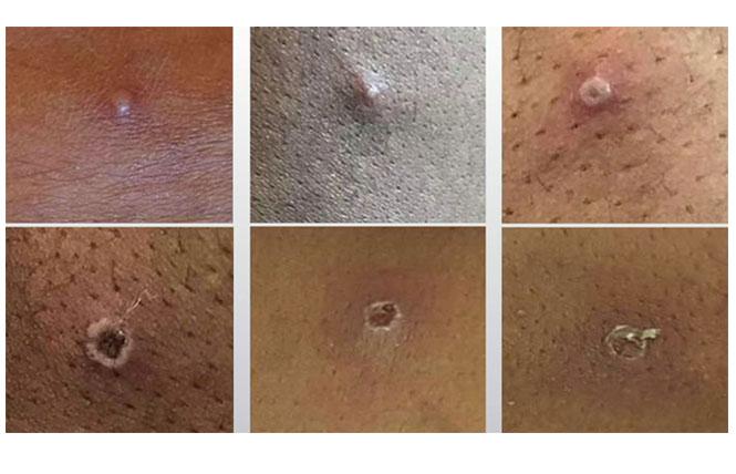 These images from the UK Health Security Agency are more representative of what the current monkeypox outbreak looks like. Photo: Courtesy UKHSA